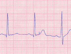 Cardiac Rhythms